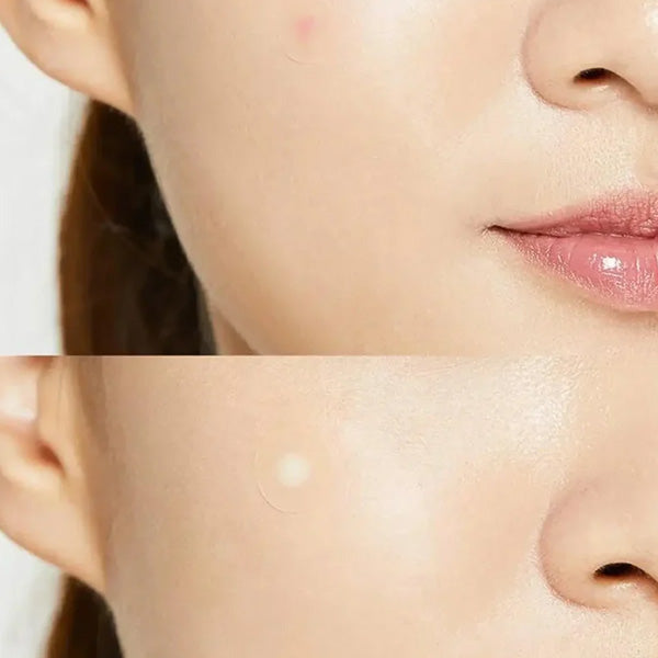 COSRX_Acne_Pimple_Master_Patch_koore.lv_pumpas_arstesana
