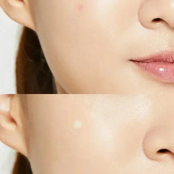 Plāksteri pūtīšu ārstēšanai | COSRX Acne pimple master patch - KOORE