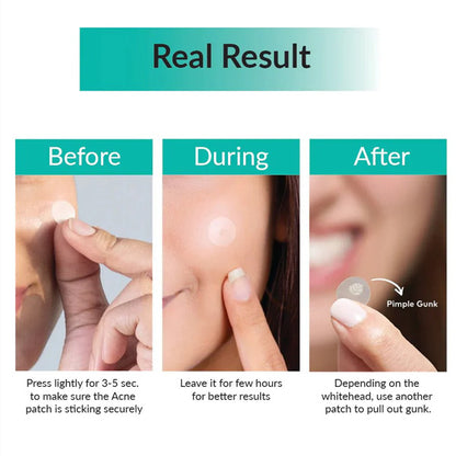 Rezultāti pēc Some By Mi 30 Days Miracle Clear Spot Patch lietošanas — āda bez izsitumiem